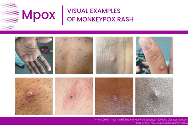 Mpox - Visual Examples of Rash - updated 2/7/23